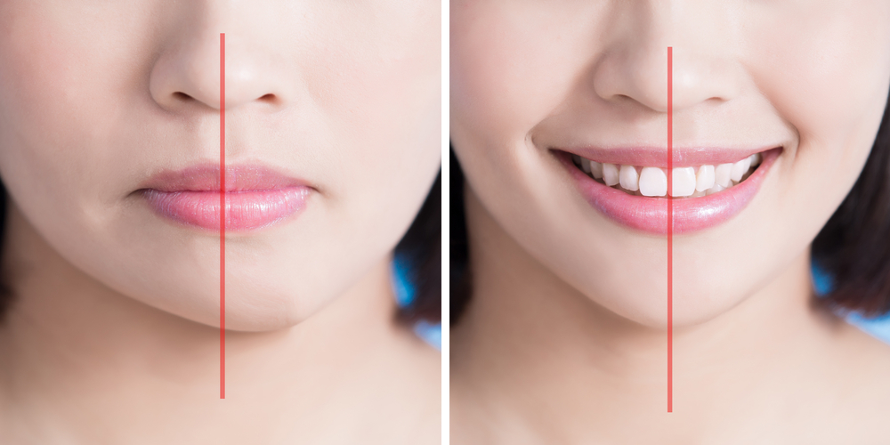 Mặt lệch là tình trạng như thế nào?